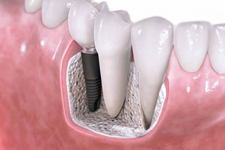          IMPLANTE DENTAL Y DIENTE EN PORCELANA.