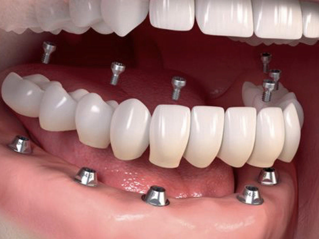 6 IMPLANTES MAS CORONAS DE PORCELANA